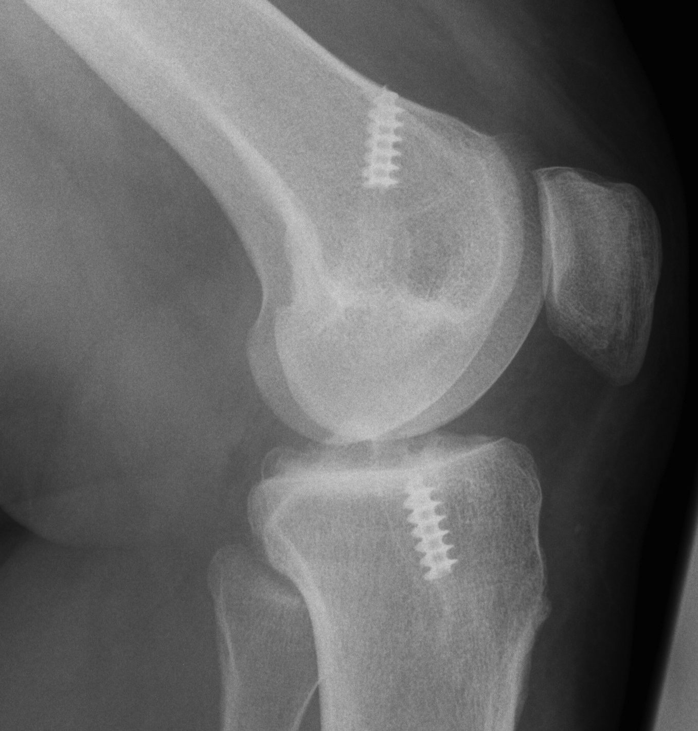 Revision ACL Lax Graft Anterior Femoral Tunnel